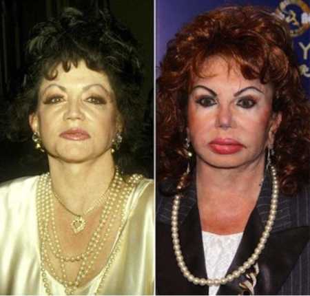 Jackie Stallone is lamenting after failing from the plastic surgery
