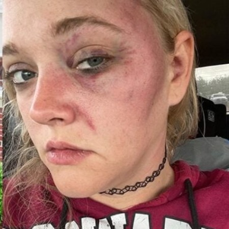 The picture of Kylie Strickland's bruised face.